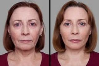 Before & After ClearLift laser