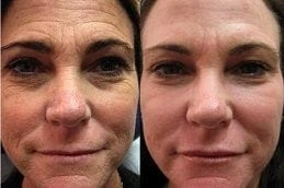 Before & After Fractional CO2 Laser Treatment Dubai