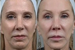 Before & After Fractional CO2 Laser Treatment in Dubai