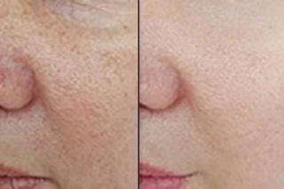 Before & After Large Pores Treatment in Dubai
