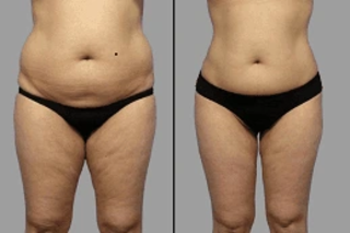 Lipolysis Treatment 6 Before & After Lipolysis Treatment in Dubai