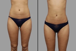 Lipolysis Treatment 5 Before & After Lipolysis Treatment