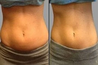 Before & After SculpSure Body Contouring in Dubai