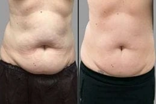 Before & After SculpSure Body Contouring