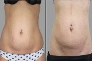 Stretch Marks Removal 6 Before & After Stretch Marks Removal