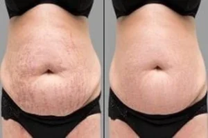 Stretch Marks Removal 5 Before & After Stretch Marks Removal in Dubai
