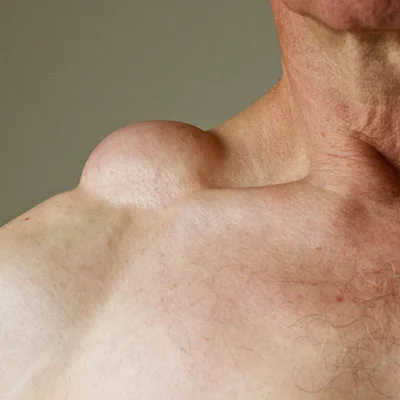 Can Lipomas Be Removed Without Surgery