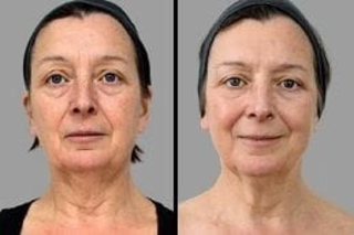 ClearLift laser in Dubai Before & After
