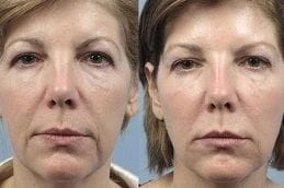 Fractional CO2 Laser Treatment 6 Fractional CO2 Laser Treatment Before & After in Dubai