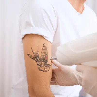 How Many Laser Sessions to Fully Remove a Tattoo