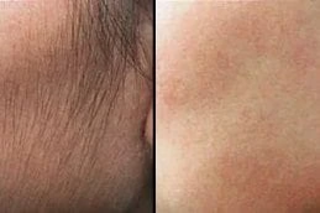 Laser Hair Bleaching Before & After