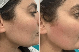 Laser-Hair-Removal-After-and-Before-in-Dubai