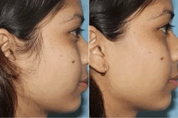 Laser Hair Removal in Dubai 6 Laser-Hair-Removal-Before-and-After