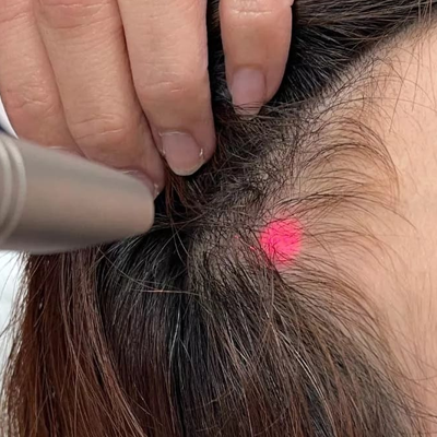 Laser Hair Therapy for Hair Loss