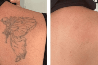 Laser Tattoo Removal Before & After in Dubai