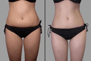 Lipolysis Treatment 4 Lipolysis Treatment Before and After
