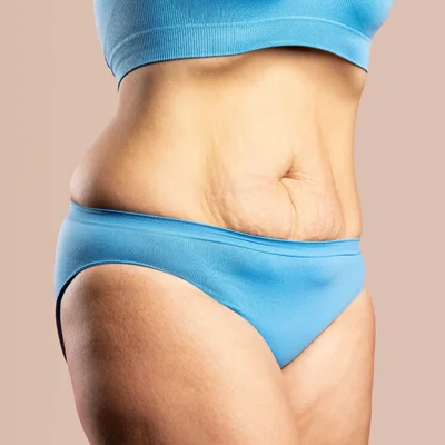 Post Weight Loss