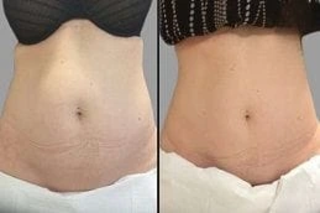 SculpSure Body Contouring Before & After