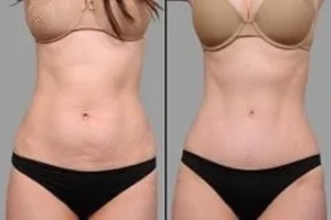 Stretch Marks Removal 4 Stretch Marks Removal Before & After