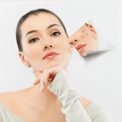 Acne Scar Treatments in Dubai
