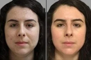 Acne Scars Treatment Before &After
