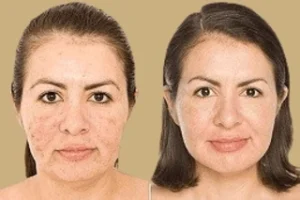 Acne Treatment Before & After