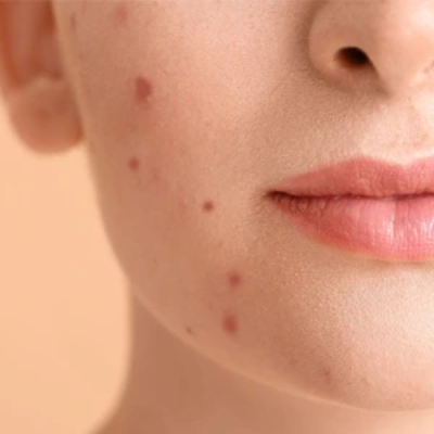 Acne Treatment in Dubai