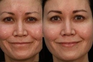 Aquagold Fine Touch Facial Before & After