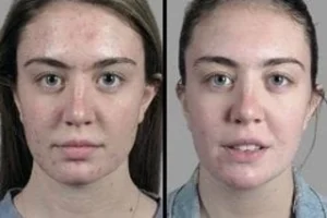Before & After Acne Scars Treatment in Dubai