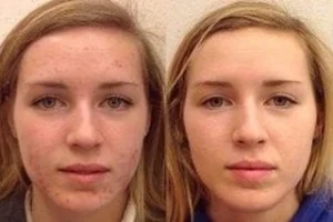 Before & After Acne Treatment