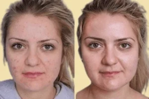 Before & After Acne Treatment in Dubai