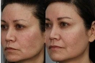 Before & After Aquagold Fine Touch Facial