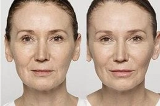 Before & After Aquagold Fine Touch Facial in Dubai