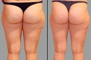Before & After Cellulite Removal in Dubai