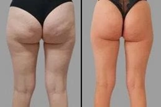 Before & After Cellulite Removal