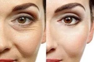 Concentrated Growth Factor 6 Before & After Concentrated Growth Factor