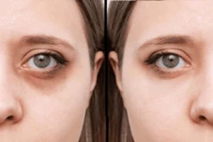 Before & After Dark Circle Treatment in Dubai