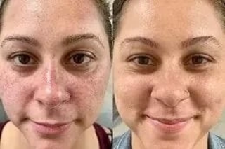 Deep Cleansing Facial 6 Before & After Deep Cleansing Facial