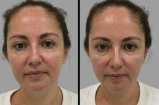 Before & After Derpamen Treatment