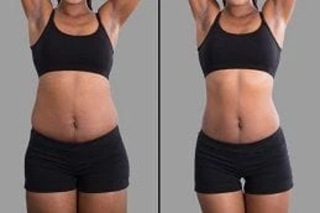 Before & After Fat Reduction