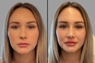 Before & After Fotona 4D Lip Augmentation