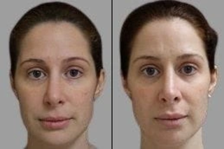 Before & After Fractional Laser PRP Therapy in Dubai