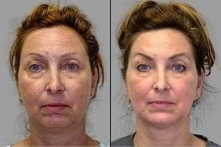 Before & After Fractional Laser PRP Therapy