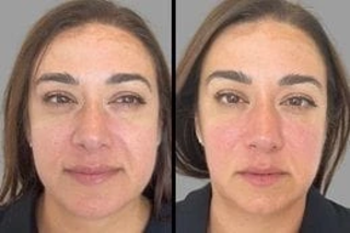 Hydrafacial in Dubai 6 Before & After Hydrafacial in Dubai