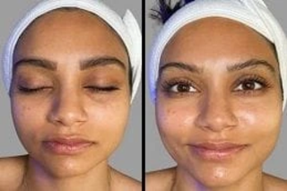 Hydrafacial in Dubai 4 Before & After Hydrafacial