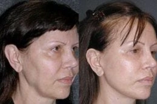 J-Plasma Skin Resurfacing 4 Before & After J-Plasma Skin Resurfacing in Dubai
