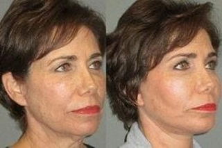 J-Plasma Skin Resurfacing 6 Before & After J-Plasma Skin Resurfacing