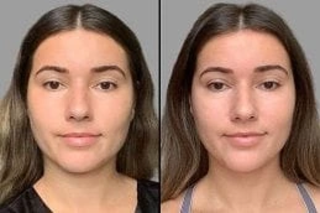 Before & After LED Light Therapy in Dubai