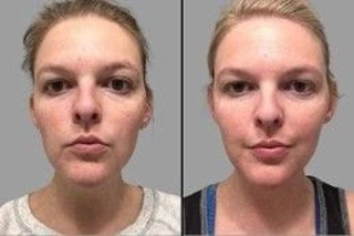 Before & After LED Light Therapy
