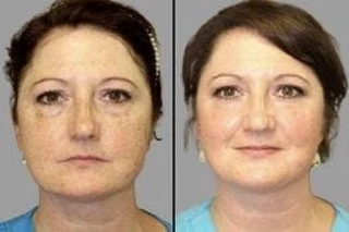 Before & After Laser Carbon Peel Dubai